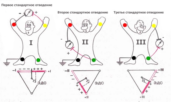 Правильная фиксация электродов