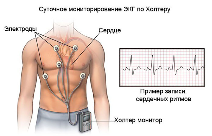 Суточное мониторирование ЭКГ по Холтеру